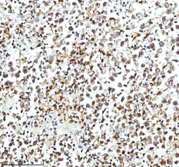 Immunohistochemical staining of Histone H3 using anti-Histone H3 antibody. Histone H3 was detected in a paraffin-embedded section of human testicular seminoma tissue. Heat mediated antigen retrieval was performed in EDTA buffer (pH 8.0, epitope retrieval solution). The tissue section was blocked with 10% goat serum. The tissue section was then incubated with 2 ug/ml rabbit anti-Histone H3 antibody overnight at 4oC. Peroxidase Conjugated Goat Anti-rabbit IgG was used as secondary antibody and incubated for 30 minutes at 37oC. The tissue section was developed using an HRP secondary and DAB substrate.