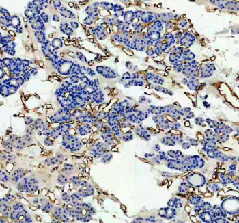 Immunohistochemical staining of ACE using anti-ACE antibody. ACE was detected in a paraffin-embedded section of human thyroid cancer tissue. Heat mediated antigen retrieval was performed in EDTA buffer (pH 8.0, epitope retrieval solution). The tissue section was blocked with 10% goat serum. The tissue section was then incubated with 2 ug/ml rabbit anti-ACE antibody overnight at 4oC. Peroxidase Conjugated Goat Anti-rabbit IgG was used as secondary antibody and incubated for 30 minutes at 37oC. The tissue section was developed using an HRP secondary and DAB substrate.