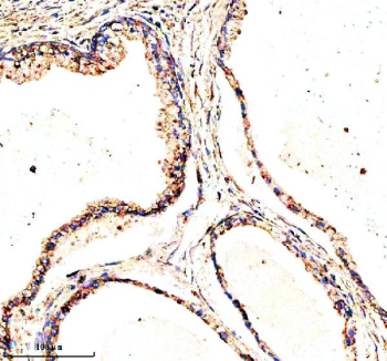 Immunohistochemical staining of MSTO1 using anti-MSTO1 antibody. MSTO1 was detected in a paraffin-embedded section of human prostate cancer tissue. Heat mediated antigen retrieval was performed in EDTA buffer (pH 8.0, epitope retrieval solution). The tissue section was blocked with 10% goat serum. The tissue section was then incubated with 2 ug/ml rabbit anti-MSTO1 antibody overnight at 4oC. Peroxidase Conjugated Goat Anti-rabbit IgG was used as secondary antibody and incubated for 30 minutes at 37oC. The tissue section was developed using an HRP secondary and DAB substrate.