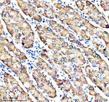 Immunohistochemical staining of MSTO1 using anti-MSTO1 antibody. MSTO1 was detected in a paraffin-embedded section of human liver cancer tissue. Heat mediated antigen retrieval was performed in EDTA buffer (pH 8.0, epitope retrieval solution). The tissue section was blocked with 10% goat serum. The tissue section was then incubated with 2 ug/ml rabbit anti-MSTO1 antibody overnight at 4oC. Peroxidase Conjugated Goat Anti-rabbit IgG was used as secondary antibody and incubated for 30 minutes at 37oC. The tissue section was developed using an HRP secondary and DAB substrate.