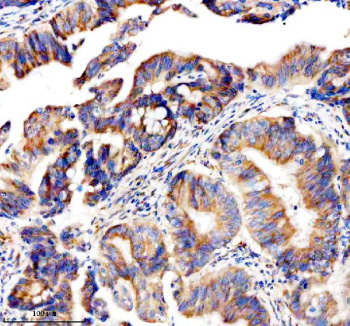 Immunohistochemical staining of GEF-H1/ARHGEF2 using anti-ARHGEF2 antibody. GEF-H1/ARHGEF2 was detected in a paraffin-embedded section of human colon cancer tissue. Heat mediated antigen retrieval was performed in EDTA buffer (pH 8.0, epitope retrieval solution). The tissue section was blocked with 10% goat serum. The tissue section was then incubated with 2 ug/ml rabbit anti-ARHGEF2 antibody overnight at 4oC. Peroxidase Conjugated Goat Anti-rabbit IgG was used as secondary antibody and incubated for 30 minutes at 37oC. The tissue section was developed using an HRP secondary and DAB substrate.