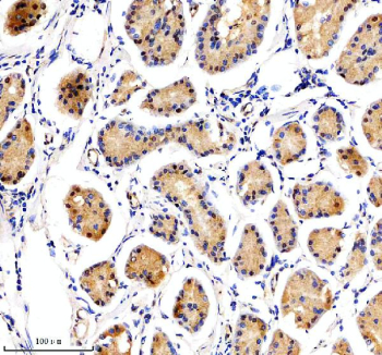 Immunohistochemical staining of NUSAP1 using anti-NUSAP1 antibody. NUSAP1 was detected in a paraffin-embedded section of human stomach cancer tissue. Heat mediated antigen retrieval was performed in EDTA buffer (pH 8.0, epitope retrieval solution). The tissue section was blocked with 10% goat serum. The tissue section was then incubated with 1:100 rabbit anti-NUSAP1 antibody overnight at 4oC. Peroxidase Conjugated Goat Anti-rabbit IgG was used as secondary antibody and incubated for 30 minutes at 37oC. The tissue section was developed using an HRP secondary and DAB substrate.