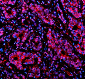 Immunofluorescent staining of NUSAP1 using anti-NUSAP1 antibody (red). NUSAP1 was detected in a paraffin-embedded section of human stomach cancer tissue. Heat mediated antigen retrieval was performed in EDTA buffer (pH 8.0, epitope retrieval solution). The tissue section was blocked with 10% goat serum. The tissue section was then incubated with 5 ug/ml rabbit anti-NUSAP1 antibody overnight at 4oC. Cy3 Conjugated Goat Anti-Rabbit IgG was used as secondary antibody at 1:500 dilution and incubated for 30 minutes at 37oC. The section was counterstained with DAPI nuclear stain (blue). Visualize using a fluorescence microscope and filter sets appropriate for the label used.