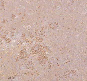 Immunohistochemical staining of SSSCA1/ZNRD2 using anti-ZNRD2 antibody. SSSCA1/ZNRD2 was detected in a paraffin-embedded section of human cervix squamous cell carcinoma tissue. Heat mediated antigen retrieval was performed in EDTA buffer (pH 8.0, epitope retrieval solution). The tissue section was blocked with 10% goat serum. The tissue section was then incubated with 2 ug/ml rabbit anti-ZNRD2 antibody overnight at 4oC. Peroxidase Conjugated Goat Anti-rabbit IgG was used as secondary antibody and incubated for 30 minutes at 37oC. The tissue section was developed using an HRP secondary and DAB substrate.