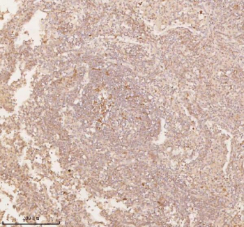 Immunohistochemical staining of SSSCA1/ZNRD2 using anti-ZNRD2 antibody. SSSCA1/ZNRD2 was detected in a paraffin-embedded section of human lung squamous cell carcinoma tissue. Heat mediated antigen retrieval was performed in EDTA buffer (pH 8.0, epitope retrieval solution). The tissue section was blocked with 10% goat serum. The tissue section was then incubated with 2 ug/ml rabbit anti-ZNRD2 antibody overnight at 4oC. Peroxidase Conjugated Goat Anti-rabbit IgG was used as secondary antibody and incubated for 30 minutes at 37oC. The tissue section was developed using an HRP secondary and DAB substrate.