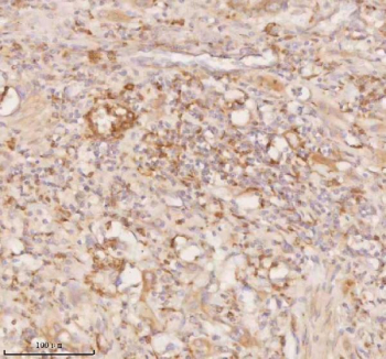 Immunohistochemical staining of SSSCA1/ZNRD2 using anti-ZNRD2 antibody. SSSCA1/ZNRD2 was detected in a paraffin-embedded section of human rectum adenocarcinoma tissue. Heat mediated antigen retrieval was performed in EDTA buffer (pH 8.0, epitope retrieval solution). The tissue section was blocked with 10% goat serum. The tissue section was then incubated with 2 ug/ml rabbit anti-ZNRD2 antibody overnight at 4oC. Peroxidase Conjugated Goat Anti-rabbit IgG was used as secondary antibody and incubated for 30 minutes at 37oC. The tissue section was developed using an HRP secondary and DAB substrate.