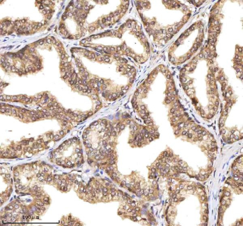 Immunohistochemical staining of RSRC2 using anti-RSRC2 antibody. RSRC2 was detected in a paraffin-embedded section of human prostate adenocarcinoma tissue. Heat mediated antigen retrieval was performed in EDTA buffer (pH 8.0, epitope retrieval solution). The tissue section was blocked with 10% goat serum. The tissue section was then incubated with 2 ug/ml rabbit anti-RSRC2 antibody overnight at 4oC. Peroxidase Conjugated Goat Anti-rabbit IgG was used as secondary antibody and incubated for 30 minutes at 37oC. The tissue section was developed using an HRP secondary and DAB substrate.