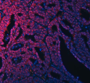 Immunofluorescent staining of FFPE human ovarian cancer tissue with RSRC2 antibody (red) and DAPI nuclear stain (blue). HIER: steam section in pH8 EDTA buffer for 20 min.