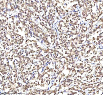 Immunohistochemical staining of RSRC2 using anti-RSRC2 antibody. RSRC2 was detected in a paraffin-embedded section of diffuse large B-cell lymphoma of human intestine tissue. Heat mediated antigen retrieval was performed in EDTA buffer (pH 8.0, epitope retrieval solution). The tissue section was blocked with 10% goat serum. The tissue section was then incubated with 2 ug/ml rabbit anti-RSRC2 antibody overnight at 4oC. Peroxidase Conjugated Goat Anti-rabbit IgG was used as secondary antibody and incubated for 30 minutes at 37oC. The tissue section was developed using an HRP secondary and DAB substrate.