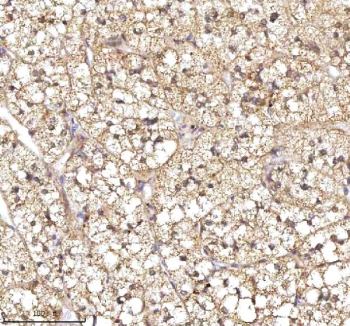 Immunohistochemical staining of RSRC2 using anti-RSRC2 antibody. RSRC2 was detected in a paraffin-embedded section of human adrenocortical adenoma tissue. Heat mediated antigen retrieval was performed in EDTA buffer (pH 8.0, epitope retrieval solution). The tissue section was blocked with 10% goat serum. The tissue section was then incubated with 2 ug/ml rabbit anti-RSRC2 antibody overnight at 4oC. Peroxidase Conjugated Goat Anti-rabbit IgG was used as secondary antibody and incubated for 30 minutes at 37oC. The tissue section was developed using an HRP secondary and DAB substrate.