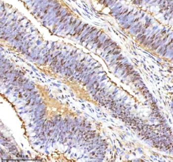 Immunohistochemical staining of RSRC2 using anti-RSRC2 antibody. RSRC2 was detected in a paraffin-embedded section of human colon adenocarcinoma tissue. Heat mediated antigen retrieval was performed in EDTA buffer (pH 8.0, epitope retrieval solution). The tissue section was blocked with 10% goat serum. The tissue section was then incubated with 2 ug/ml rabbit anti-RSRC2 antibody overnight at 4oC. Peroxidase Conjugated Goat Anti-rabbit IgG was used as secondary antibody and incubated for 30 minutes at 37oC. The tissue section was developed using an HRP secondary and DAB substrate.
