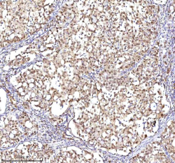 Immunohistochemical staining of RSRC2 using anti-RSRC2 antibody. RSRC2 was detected in a paraffin-embedded section of human ovary serous carcinoma tissue. Heat mediated antigen retrieval was performed in EDTA buffer (pH 8.0, epitope retrieval solution). The tissue section was blocked with 10% goat serum. The tissue section was then incubated with 2 ug/ml rabbit anti-RSRC2 antibody overnight at 4oC. Peroxidase Conjugated Goat Anti-rabbit IgG was used as secondary antibody and incubated for 30 minutes at 37oC. The tissue section was developed using an HRP secondary and DAB substrate.