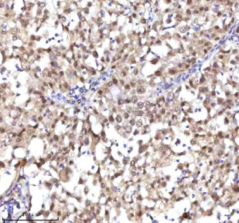 Immunohistochemical staining of RSRC2 using anti-RSRC2 antibody. RSRC2 was detected in a paraffin-embedded section of human ovary serous carcinoma tissue. Heat mediated antigen retrieval was performed in EDTA buffer (pH 8.0, epitope retrieval solution). The tissue section was blocked with 10% goat serum. The tissue section was then incubated with 2 ug/ml rabbit anti-RSRC2 antibody overnight at 4oC. Peroxidase Conjugated Goat Anti-rabbit IgG was used as secondary antibody and incubated for 30 minutes at 37oC. The tissue section was developed using an HRP secondary and DAB substrate.