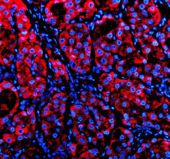 P4HA1 Antibody Human Liver Cancer IF. Immunofluorescence was performed on FFPE human liver cancer tissue using P4HA1 Antibody (red). Heat-induced epitope retrieval was carried out in pH 8 EDTA buffer prior to incubation with the primary antibody at 5 ug/ml. A Cy3-conjugated goat anti-rabbit IgG secondary antibody was used for detection, and nuclei were counterstained with DAPI (blue). Strong cytoplasmic staining is observed throughout the tumor cells, consistent with the endoplasmic reticulum localization of P4HA1 as a key enzyme involved in collagen biosynthesis and extracellular matrix remodeling. These results demonstrate that this Collagen Biosynthesis Enzyme Antibody is suitable for immunofluorescent detection of P4HA1 in formalin-fixed, paraffin-embedded human liver cancer tissue.