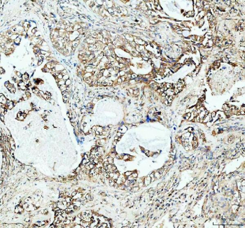 P4HA1 Antibody Human Lung Cancer IHC. Immunohistochemistry was performed on FFPE human lung cancer tissue using P4HA1 Antibody. Heat-induced epitope retrieval was carried out in pH 8 EDTA buffer prior to incubation with the primary antibody at a 1:100 dilution. Bound antibody was detected using an HRP-conjugated goat anti-rabbit IgG secondary antibody with DAB chromogen. Moderate to strong cytoplasmic staining is observed throughout the neoplastic epithelial cells, consistent with increased P4HA1 expression associated with collagen biosynthesis, extracellular matrix remodeling, and tumor progression. These results demonstrate that this Collagen Biosynthesis Enzyme Antibody is suitable for immunohistochemical detection of P4HA1 in formalin-fixed, paraffin-embedded human lung cancer tissue.