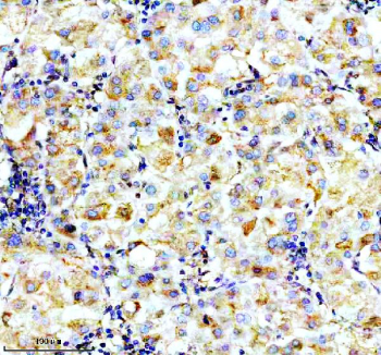 P4HA1 Antibody Human Liver Cancer IHC. Immunohistochemistry was performed on FFPE human liver cancer tissue using P4HA1 Antibody. Heat-induced epitope retrieval was carried out in pH 8 EDTA buffer prior to incubation with the primary antibody at 2 ug/ml. Bound antibody was detected using an HRP-conjugated goat anti-rabbit IgG secondary antibody with DAB chromogen. Moderate to strong cytoplasmic staining is observed throughout the malignant hepatocytes, consistent with elevated P4HA1 expression associated with collagen biosynthesis, extracellular matrix remodeling, and hypoxia-driven tumor progression. These results demonstrate that this Collagen Biosynthesis Enzyme Antibody is suitable for immunohistochemical detection of P4HA1 in formalin-fixed, paraffin-embedded human liver cancer tissue.