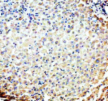 P4HA1 Antibody Human Liver IHC. Immunohistochemistry was performed on FFPE human liver tissue using P4HA1 Antibody. Heat-induced epitope retrieval was carried out in pH 8 EDTA buffer prior to incubation with the primary antibody at 2 ug/ml. Bound antibody was detected using an HRP-conjugated goat anti-rabbit IgG secondary antibody with DAB chromogen. Moderate diffuse cytoplasmic staining is observed in hepatocytes, consistent with the constitutive expression of P4HA1 as an essential enzyme involved in collagen biosynthesis and extracellular matrix homeostasis. These results demonstrate that this Collagen Biosynthesis Enzyme Antibody is suitable for immunohistochemical detection of P4HA1 in formalin-fixed, paraffin-embedded human liver tissue.