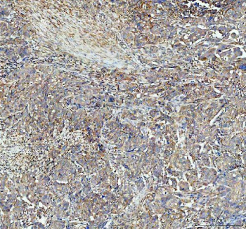P4HA1 Antibody Human Ovarian Cancer IHC. Immunohistochemistry was performed on FFPE human ovarian cancer tissue using P4HA1 Antibody. Heat-induced epitope retrieval was carried out in pH 8 EDTA buffer prior to incubation with the primary antibody at a 1:100 dilution. Bound antibody was detected using an HRP-conjugated goat anti-rabbit IgG secondary antibody with DAB chromogen. Moderate to strong cytoplasmic staining is observed throughout the neoplastic cells, consistent with elevated P4HA1 expression associated with collagen biosynthesis, extracellular matrix remodeling, and tumor progression. These results demonstrate that this Collagen Biosynthesis Enzyme Antibody is suitable for immunohistochemical detection of P4HA1 in formalin-fixed, paraffin-embedded human ovarian cancer tissue.