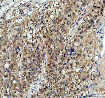Immunohistochemical staining of TAF3 using anti-TAF3 antibody. TAF3 was detected in a paraffin-embedded section of human ovarian cancer tissue. Heat mediated antigen retrieval was performed in EDTA buffer (pH 8.0, epitope retrieval solution). The tissue section was blocked with 10% goat serum. The tissue section was then incubated with 2 ug/ml rabbit anti-TAF3 antibody overnight at 4oC. Peroxidase Conjugated Goat Anti-rabbit IgG was used as secondary antibody and incubated for 30 minutes at 37oC. The tissue section was developed using an HRP secondary and DAB substrate.