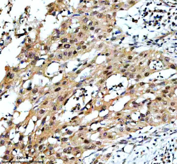 Immunohistochemical staining of TAF3 using anti-TAF3 antibody. TAF3 was detected in a paraffin-embedded section of human bladder cancer tissue. Heat mediated antigen retrieval was performed in EDTA buffer (pH 8.0, epitope retrieval solution). The tissue section was blocked with 10% goat serum. The tissue section was then incubated with 2 ug/ml rabbit anti-TAF3 antibody overnight at 4oC. Peroxidase Conjugated Goat Anti-rabbit IgG was used as secondary antibody and incubated for 30 minutes at 37oC. The tissue section was developed using an HRP secondary and DAB substrate.