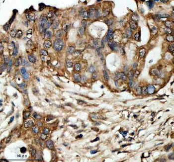 Immunohistochemical staining of LRG1 using anti-LRG1 antibody. LRG1 was detected in a paraffin-embedded section of human pancreas cancer tissue. Heat mediated antigen retrieval was performed in EDTA buffer (pH 8.0, epitope retrieval solution). The tissue section was blocked with 10% goat serum. The tissue section was then incubated with 2 ug/ml rabbit anti-LRG1 antibody overnight at 4oC. Peroxidase Conjugated Goat Anti-rabbit IgG was used as secondary antibody and incubated for 30 minutes at 37oC. The tissue section was developed using an HRP secondary and DAB substrate.