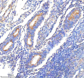 Immunohistochemical staining of CLTB using anti-CLTB antibody. CLTB was detected in a paraffin-embedded section of human endometrial cancer tissue. Heat mediated antigen retrieval was performed in EDTA buffer (pH 8.0, epitope retrieval solution). The tissue section was blocked with 10% goat serum. The tissue section was then incubated with 2 ug/ml rabbit anti-CLTB antibody overnight at 4oC. Peroxidase Conjugated Goat Anti-rabbit IgG was used as secondary antibody and incubated for 30 minutes at 37oC. The tissue section was developed using an HRP secondary and DAB substrate.
