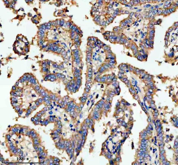 Immunohistochemical staining of NSDHL using anti-NSDHL antibody. NSDHL was detected in a paraffin-embedded section of human lung cancer tissue. Heat mediated antigen retrieval was performed in EDTA buffer (pH 8.0, epitope retrieval solution). The tissue section was blocked with 10% goat serum. The tissue section was then incubated with 2 ug/ml rabbit anti-NSDHL antibody overnight at 4oC. Peroxidase Conjugated Goat Anti-rabbit IgG was used as secondary antibody and incubated for 30 minutes at 37oC. The tissue section was developed using an HRP secondary and DAB substrate.