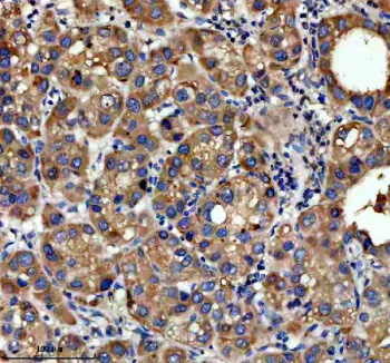 Immunohistochemical staining of NSDHL using anti-NSDHL antibody. NSDHL was detected in a paraffin-embedded section of human liver cancer tissue. Heat mediated antigen retrieval was performed in EDTA buffer (pH 8.0, epitope retrieval solution). The tissue section was blocked with 10% goat serum. The tissue section was then incubated with 2 ug/ml rabbit anti-NSDHL antibody overnight at 4oC. Peroxidase Conjugated Goat Anti-rabbit IgG was used as secondary antibody and incubated for 30 minutes at 37oC. The tissue section was developed using an HRP secondary and DAB substrate.