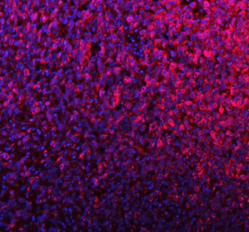 PMEL Antibody for IF / Premelanosome Protein Antibody immunofluorescence analysis in human melanoma tissue. FFPE human melanoma section shows strong red fluorescent cytoplasmic staining in melanoma cells corresponding to premelanosome-associated localization of PMEL (SILV/gp100). The staining pattern appears as punctate vesicular fluorescence within the cytoplasm of tumor cells, consistent with melanosome and premelanosome structures characteristic of melanocytic lineage cells. Nuclei are counterstained with DAPI (blue). Heat mediated antigen retrieval was performed in EDTA buffer (pH 8.0) prior to antibody incubation, followed by detection with DyLight 594-conjugated goat anti-rabbit IgG secondary antibody and visualization by fluorescence microscopy.