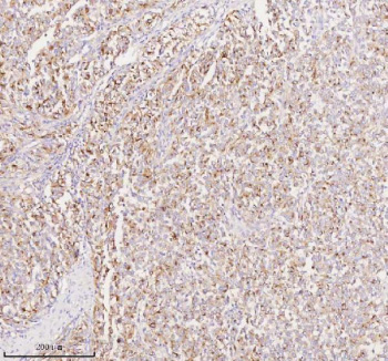 Immunohistochemical staining of SILV/PMEL using anti-PMEL antibody. SILV/PMEL was detected in a paraffin-embedded section of human melanoma tissue. Heat mediated antigen retrieval was performed in EDTA buffer (pH 8.0, epitope retrieval solution). The tissue section was blocked with 10% goat serum. The tissue section was then incubated with 2 ug/ml rabbit anti-PMEL antibody overnight at 4oC. Peroxidase Conjugated Goat Anti-rabbit IgG was used as secondary antibody and incubated for 30 minutes at 37oC. The tissue section was developed using an HRP secondary and DAB substrate.