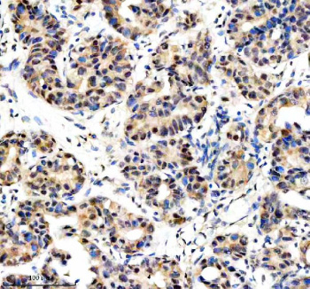 Immunohistochemical staining of DKC1 using anti-DKC1 antibody. DKC1 was detected in a paraffin-embedded section of human breast cancer tissue. Heat mediated antigen retrieval was performed in EDTA buffer (pH 8.0, epitope retrieval solution). The tissue section was blocked with 10% goat serum. The tissue section was then incubated with 2 ug/ml rabbit anti-DKC1 antibody overnight at 4oC. Peroxidase Conjugated Goat Anti-rabbit IgG was used as secondary antibody and incubated for 30 minutes at 37oC. The tissue section was developed using an HRP secondary and DAB substrate.