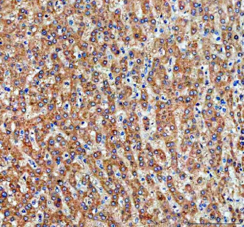 Immunohistochemical staining of PGAM5 using anti-PGAM5 antibody. PGAM5 was detected in a paraffin-embedded section of human liver cancer tissue. Heat mediated antigen retrieval was performed in EDTA buffer (pH 8.0, epitope retrieval solution). The tissue section was blocked with 10% goat serum. The tissue section was then incubated with 1:100 rabbit anti-PGAM5 antibody overnight at 4oC. Peroxidase Conjugated Goat Anti-rabbit IgG was used as secondary antibody and incubated for 30 minutes at 37oC. The tissue section was developed using an HRP secondary and DAB substrate.