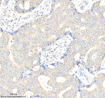 Immunohistochemical staining of Biglycan/BGN using anti-BGN antibody. Biglycan/BGN was detected in a paraffin-embedded section of human breast cancer tissue. Heat mediated antigen retrieval was performed in EDTA buffer (pH 8.0, epitope retrieval solution). The tissue section was blocked with 10% goat serum. The tissue section was then incubated with 2 ug/ml rabbit anti-BGN antibody overnight at 4oC. Peroxidase Conjugated Goat Anti-rabbit IgG was used as secondary antibody and incubated for 30 minutes at 37oC. The tissue section was developed using an HRP secondary and DAB substrate.