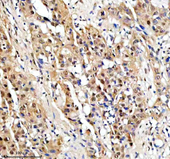 Immunohistochemical staining of PSMD5 using anti-PSMD5 antibody. PSMD5 was detected in a paraffin-embedded section of human bladder cancer tissue. Heat mediated antigen retrieval was performed in EDTA buffer (pH 8.0, epitope retrieval solution). The tissue section was blocked with 10% goat serum. The tissue section was then incubated with 2 ug/ml rabbit anti-PSMD5 antibody overnight at 4oC. Peroxidase Conjugated Goat Anti-rabbit IgG was used as secondary antibody and incubated for 30 minutes at 37oC. The tissue section was developed using an HRP secondary and DAB substrate.