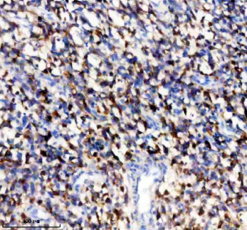 Immunohistochemical staining of TYRP1 using anti-TYRP1 antibody. TYRP1 was detected in a paraffin-embedded section of human melanoma tissue. Heat mediated antigen retrieval was performed in EDTA buffer (pH 8.0, epitope retrieval solution). The tissue section was blocked with 10% goat serum. The tissue section was then incubated with 2 ug/ml rabbit anti-TYRP1 antibody overnight at 4oC. Peroxidase Conjugated Goat Anti-rabbit IgG was used as secondary antibody and incubated for 30 minutes at 37oC. The tissue section was developed using an HRP secondary and DAB substrate.