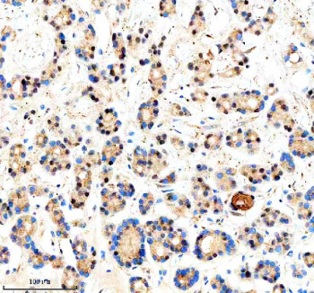 Immunohistochemical staining of CREB3L2 using anti-CREB3L2 antibody. CREB3L2 was detected in a paraffin-embedded section of human thyroid cancer tissue. Heat mediated antigen retrieval was performed in EDTA buffer (pH 8.0, epitope retrieval solution). The tissue section was blocked with 10% goat serum. The tissue section was then incubated with 2 ug/ml rabbit anti-CREB3L2 antibody overnight at 4oC. Peroxidase Conjugated Goat Anti-rabbit IgG was used as secondary antibody and incubated for 30 minutes at 37oC. The tissue section was developed using an HRP secondary and DAB substrate.
