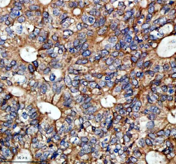 Immunohistochemical staining of SESN2 using anti-SESN2 antibody. SESN2 was detected in a paraffin-embedded section of human colon cancer tissue. Heat mediated antigen retrieval was performed in EDTA buffer (pH 8.0, epitope retrieval solution). The tissue section was blocked with 10% goat serum. The tissue section was then incubated with 2 ug/ml rabbit anti-SESN2 antibody overnight at 4oC. Peroxidase Conjugated Goat Anti-rabbit IgG was used as secondary antibody and incubated for 30 minutes at 37oC. The tissue section was developed using an HRP secondary and DAB substrate.