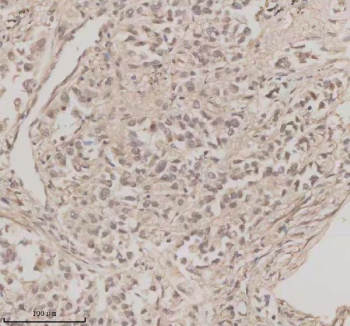 Immunohistochemical staining of OAZ1 using anti-OAZ1 antibody. OAZ1 was detected in a paraffin-embedded section of human lung cancer tissue. Heat mediated antigen retrieval was performed in EDTA buffer (pH 8.0, epitope retrieval solution). The tissue section was blocked with 10% goat serum. The tissue section was then incubated with 2 ug/ml rabbit anti-OAZ1 antibody overnight at 4oC. Peroxidase Conjugated Goat Anti-rabbit IgG was used as secondary antibody and incubated for 30 minutes at 37oC. The tissue section was developed using an HRP secondary and DAB substrate.