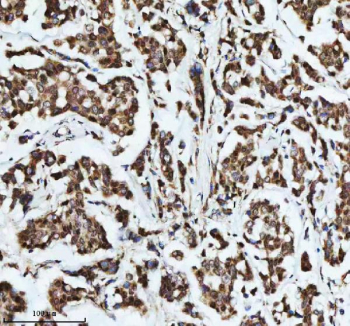 Immunohistochemical staining of DIS3 using anti-DIS3 antibody. DIS3 was detected in a paraffin-embedded section of human breast cancer tissue. Heat mediated antigen retrieval was performed in EDTA buffer (pH 8.0, epitope retrieval solution). The tissue section was blocked with 10% goat serum. The tissue section was then incubated with 2 ug/ml rabbit anti-DIS3 antibody overnight at 4oC. Peroxidase Conjugated Goat Anti-rabbit IgG was used as secondary antibody and incubated for 30 minutes at 37oC. The tissue section was developed using an HRP secondary and DAB substrate.