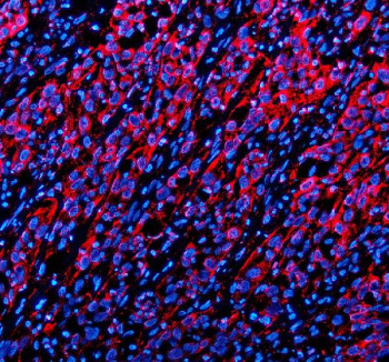 Immunofluorescent staining of TWSG1 using anti-TWSG1 antibody (red). TWSG1 was detected in a paraffin-embedded section of human bladder cancer tissue. Heat mediated antigen retrieval was performed in EDTA buffer (pH 8.0, epitope retrieval solution). The tissue section was blocked with 10% goat serum. The tissue section was then incubated with 5 ug/ml rabbit anti-TWSG1 antibody overnight at 4oC. Cy3 Conjugated Goat Anti-Rabbit IgG was used as secondary antibody at 1:500 dilution and incubated for 30 minutes at 37oC. The section was counterstained with DAPI nuclear stain (blue). Visualize using a fluorescence microscope and filter sets appropriate for the label used.