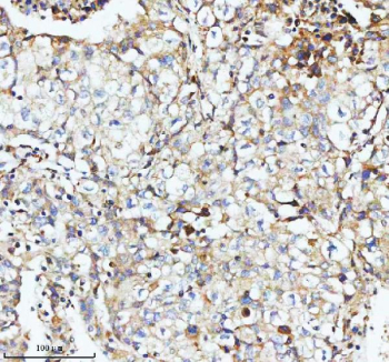 Immunohistochemical staining of SBK1 using anti-SBK1 antibody. SBK1 was detected in a paraffin-embedded section of human lung cancer tissue. Heat mediated antigen retrieval was performed in EDTA buffer (pH 8.0, epitope retrieval solution). The tissue section was blocked with 10% goat serum. The tissue section was then incubated with 2 ug/ml rabbit anti-SBK1 antibody overnight at 4oC. Peroxidase Conjugated Goat Anti-rabbit IgG was used as secondary antibody and incubated for 30 minutes at 37oC. The tissue section was developed using an HRP secondary and DAB substrate.