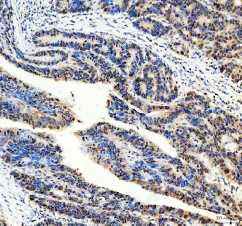 DNMT3A Antibody Colon Cancer Tissue IHC. Immunohistochemistry analysis of FFPE human colon carcinoma tissue using DNMT3A Antibody shows strong nuclear HRP-DAB brown staining in tumor epithelial cells, consistent with localization of DNMT3A / DNA methyltransferase 3 alpha as a nuclear epigenetic regulator. Positive nuclei are distributed throughout malignant glandular structures, while surrounding stromal regions display lower staining intensity. Hematoxylin counterstain provides nuclear contrast and tissue architecture. HIER: heat-mediated antigen retrieval in EDTA buffer (pH 8.0).