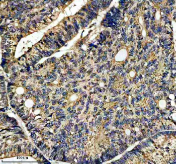 Immunohistochemical staining of IFT20 using anti-IFT20 antibody. IFT20 was detected in a paraffin-embedded section of human colon cancer tissue. Heat mediated antigen retrieval was performed in EDTA buffer (pH 8.0, epitope retrieval solution). The tissue section was blocked with 10% goat serum. The tissue section was then incubated with 2 ug/ml rabbit anti-IFT20 antibody overnight at 4oC. Peroxidase Conjugated Goat Anti-rabbit IgG was used as secondary antibody and incubated for 30 minutes at 37oC. The tissue section was developed using an HRP secondary and DAB substrate.
