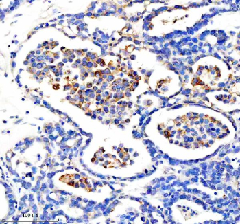 Immunohistochemical staining of CYP2W1 using anti-CYP2W1 antibody. CYP2W1 was detected in a paraffin-embedded section of human ovarian cancer tissue. Heat mediated antigen retrieval was performed in EDTA buffer (pH 8.0, epitope retrieval solution). The tissue section was blocked with 10% goat serum. The tissue section was then incubated with 2 ug/ml rabbit anti-CYP2W1 antibody overnight at 4oC. Peroxidase Conjugated Goat Anti-rabbit IgG was used as secondary antibody and incubated for 30 minutes at 37oC. The tissue section was developed using an HRP secondary and DAB substrate.