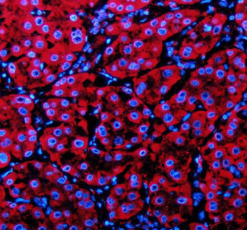 Immunofluorescent staining of PECR using anti-PECR antibody (red). PECR was detected in a paraffin-embedded section of human liver cancer tissue. Heat mediated antigen retrieval was performed in EDTA buffer (pH 8.0, epitope retrieval solution). The tissue section was blocked with 10% goat serum. The tissue section was then incubated with 5 ug/ml rabbit anti-PECR antibody overnight at 4oC. Cy3 Conjugated Goat Anti-Rabbit IgG was used as secondary antibody at 1:500 dilution and incubated for 30 minutes at 37oC. The section was counterstained with DAPI nuclear stain (blue). Visualize using a fluorescence microscope and filter sets appropriate for the label used.