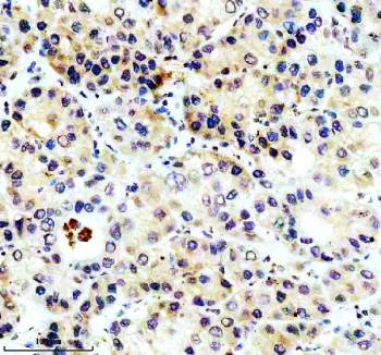Immunohistochemical staining of PECR using anti-PECR antibody. PECR was detected in a paraffin-embedded section of human liver cancer tissue. Heat mediated antigen retrieval was performed in EDTA buffer (pH 8.0, epitope retrieval solution). The tissue section was blocked with 10% goat serum. The tissue section was then incubated with 2 ug/ml rabbit anti-PECR antibody overnight at 4oC. Peroxidase Conjugated Goat Anti-rabbit IgG was used as secondary antibody and incubated for 30 minutes at 37oC. The tissue section was developed using an HRP secondary and DAB substrate.
