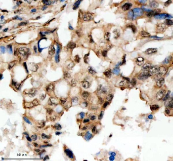 Immunohistochemical staining of SCAF11 using anti-SCAF11 antibody. SCAF11 was detected in a paraffin-embedded section of human lung cancer tissue. Heat mediated antigen retrieval was performed in EDTA buffer (pH 8.0, epitope retrieval solution). The tissue section was blocked with 10% goat serum. The tissue section was then incubated with 2 ug/ml rabbit anti-SCAF11 antibody overnight at 4oC. Peroxidase Conjugated Goat Anti-rabbit IgG was used as secondary antibody and incubated for 30 minutes at 37oC. The tissue section was developed using an HRP secondary and DAB substrate.