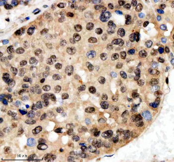 Immunohistochemical staining of SCAF11 using anti-SCAF11 antibody. SCAF11 was detected in a paraffin-embedded section of human liver cancer tissue. Heat mediated antigen retrieval was performed in EDTA buffer (pH 8.0, epitope retrieval solution). The tissue section was blocked with 10% goat serum. The tissue section was then incubated with 2 ug/ml rabbit anti-SCAF11 antibody overnight at 4oC. Peroxidase Conjugated Goat Anti-rabbit IgG was used as secondary antibody and incubated for 30 minutes at 37oC. The tissue section was developed using an HRP secondary and DAB substrate.