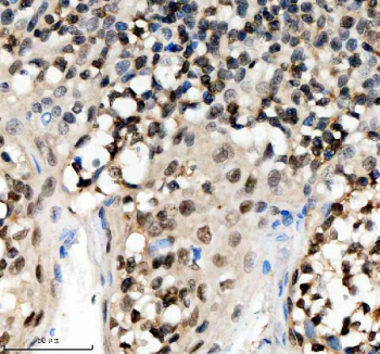 Immunohistochemical staining of SCAF11 using anti-SCAF11 antibody. SCAF11 was detected in a paraffin-embedded section of human tonsil tissue. Heat mediated antigen retrieval was performed in EDTA buffer (pH 8.0, epitope retrieval solution). The tissue section was blocked with 10% goat serum. The tissue section was then incubated with 2 ug/ml rabbit anti-SCAF11 antibody overnight at 4oC. Peroxidase Conjugated Goat Anti-rabbit IgG was used as secondary antibody and incubated for 30 minutes at 37oC. The tissue section was developed using an HRP secondary and DAB substrate.