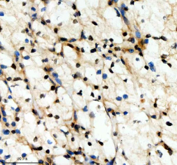 Immunohistochemical staining of SCAF11 using anti-SCAF11 antibody. SCAF11 was detected in a paraffin-embedded section of human renal cancer tissue. Heat mediated antigen retrieval was performed in EDTA buffer (pH 8.0, epitope retrieval solution). The tissue section was blocked with 10% goat serum. The tissue section was then incubated with 2 ug/ml rabbit anti-SCAF11 antibody overnight at 4oC. Peroxidase Conjugated Goat Anti-rabbit IgG was used as secondary antibody and incubated for 30 minutes at 37oC. The tissue section was developed using an HRP secondary and DAB substrate.